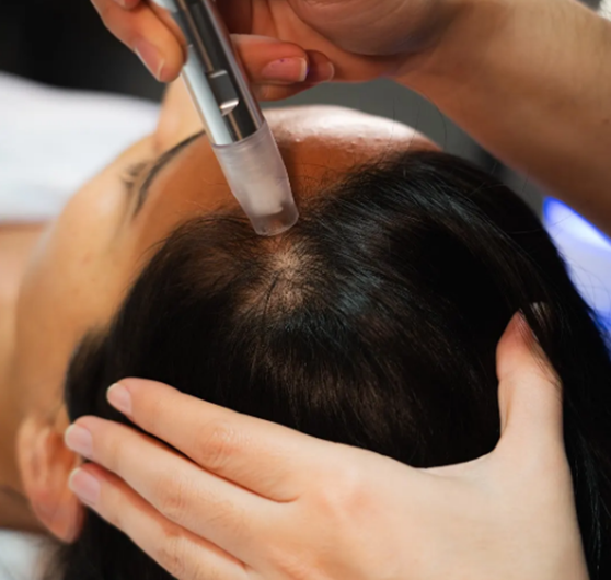 Bio Microneedling Spots 