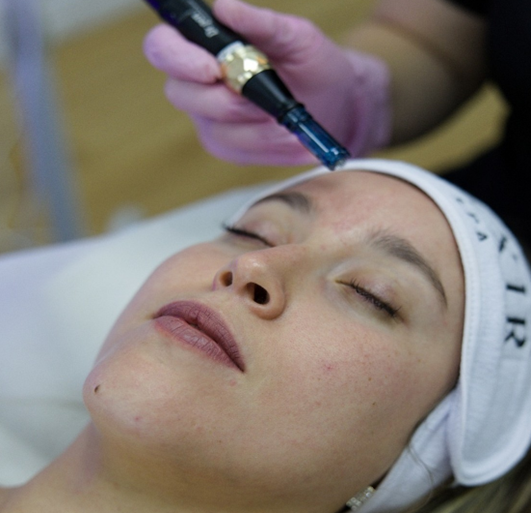 Microneedling